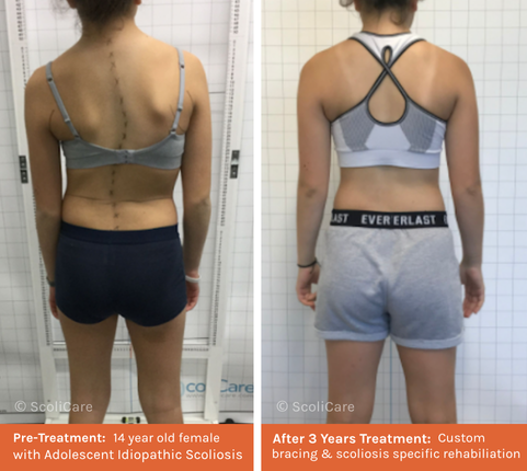 AIS (1) Adolescent Idiopathic Scoliosis