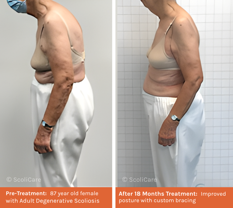 Adult (1) Adult Scoliosis