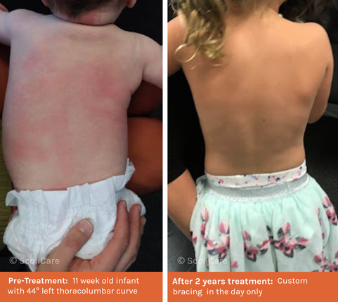 Infantile (1) Infantile Scoliosis1