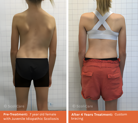 Juvenile (1) Juvenile Scoliosis